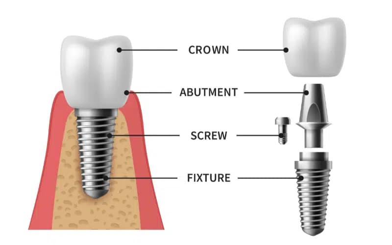 Digital implant planning on large monitor